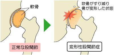変形性股関節症の症状